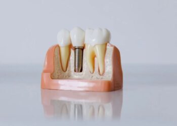 All-On-4 Dental Implants A Comprehensive Guide to Restoring Your Smile