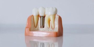All-On-4 Dental Implants A Comprehensive Guide to Restoring Your Smile