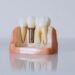 All-On-4 Dental Implants A Comprehensive Guide to Restoring Your Smile