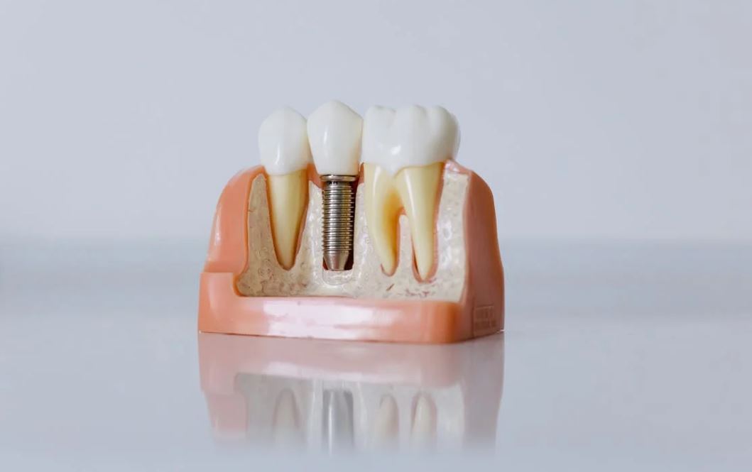All-On-4 Dental Implants A Comprehensive Guide to Restoring Your Smile
