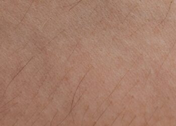 Sebaceous Hyperplasia Before and After Photos Real Results