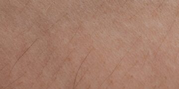 Sebaceous Hyperplasia Before and After Photos Real Results