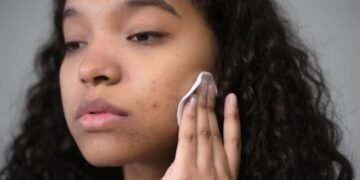 Can Ashwagandha Cause Acne What the Evidence Says