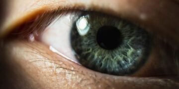 Central Heterochromia vs. Hazel How to Tell