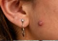 keloid-vs-piercing-bump