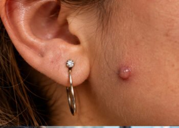 keloid-vs-piercing-bump