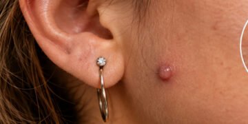 keloid-vs-piercing-bump