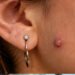 keloid-vs-piercing-bump